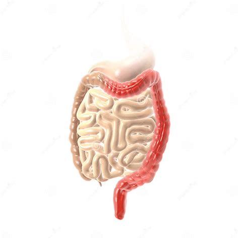 Ulcerative Colitis Uc Inflammation And Ulcers Of The Colon And Rectus Medically Illustration