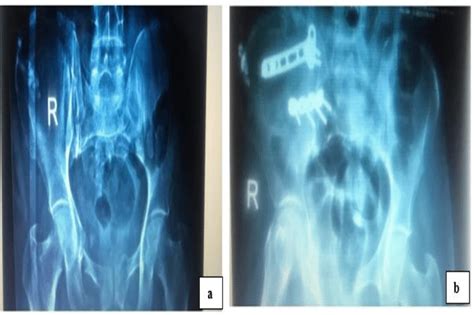 A Pre Operative X Ray And B Postoperative X Ray Download Scientific Diagram