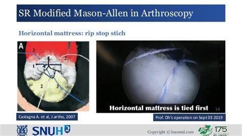 Modified Mason Allen Technique For Rotator Cuff Repair