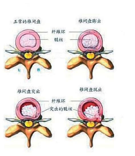 椎腰篇 腰突治療：保守，還是手術？ 每日頭條