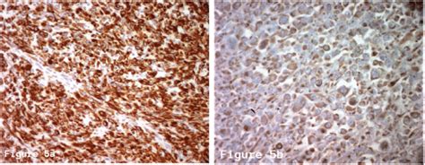 Immunohistochemistry 5a Cytokeratin Ae1 Ae3 100 Strongly And