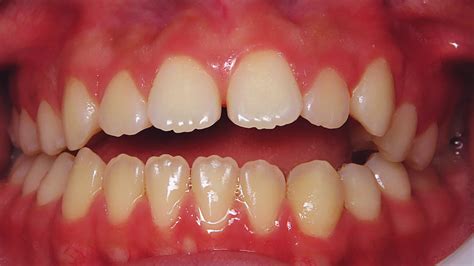 Class Iii Malocclusion Anterior Open Bite Excessive Overbite Asymmetry Case Gallery