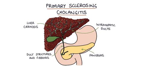 Psc Primary Sclerosing Cholangitis Dr Kiran Peddi