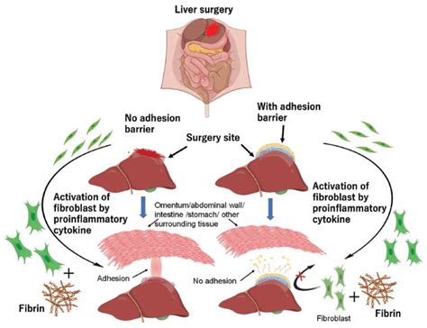 A Schematic Representation Of The Role Of Fibrin And Fibroblasts In The