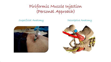 Piriformis Muscle Injection Personal Approach Youtube