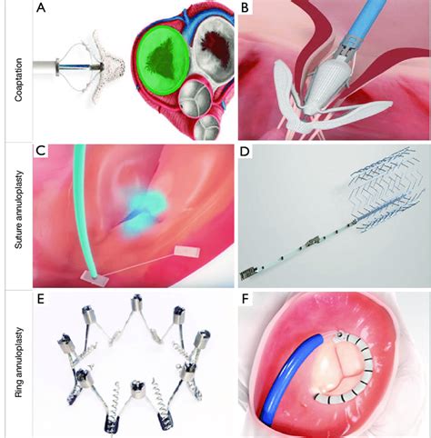 Transcatheter Tricuspid Repair Devices There Are Several Techniques To