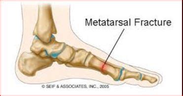 Metatarsal Fracture - Symptoms, Causes, Treatment