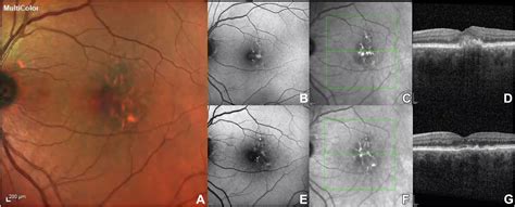 Predictive Factors Influencing The Evolution Of Acquired Vitelliform Lesions In Intermediate Age