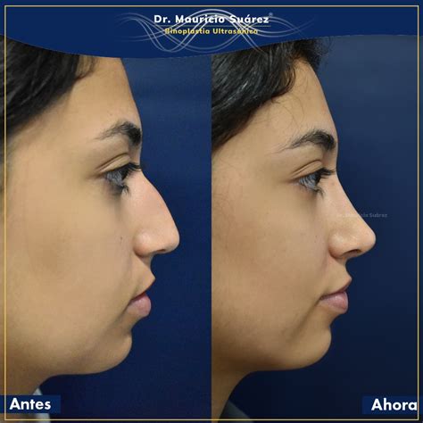 Rinoplastia Ultrasónica Colombia Doctor Mauricio Suárez