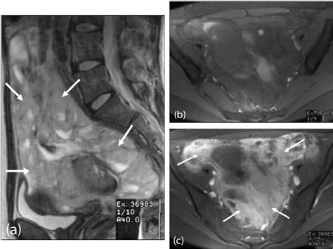 Desmoplastic Small Round Cell Tumour Mri Pelvis A Sagittal