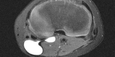 The MRI Appearance and Significance of the Popliteal Cyst - Illinois ...