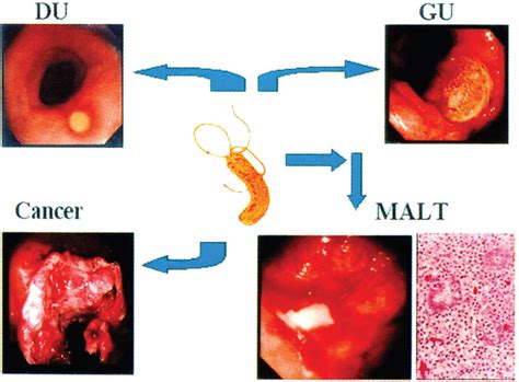 Helicobacter Pylori The Unique Organism Annals Of Saudi Medicine