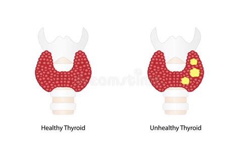 Thyroid Cancer, Unhealthy Thyroid with Inflammation and Lump. Stock ...