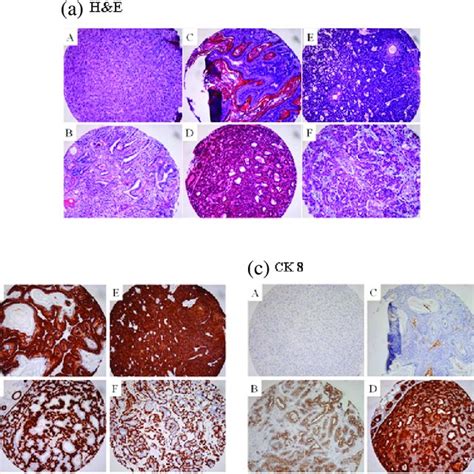 Estrogen Receptor A Expression In Dmba Induced Mammary Tumors And