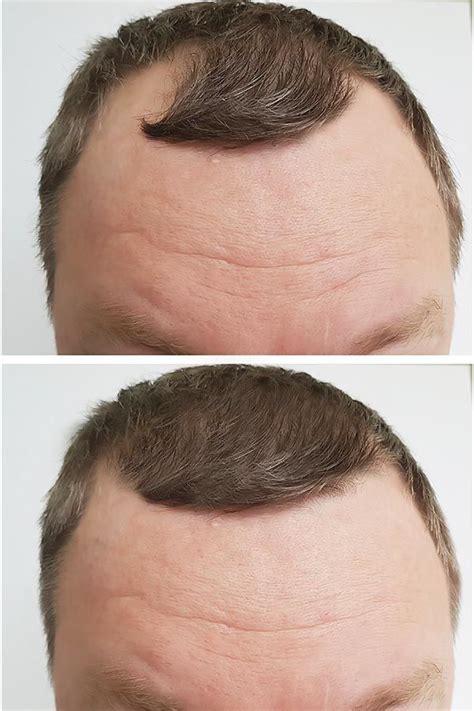 The Complete Guide To A Hair Transplant Procedure With Faqs Answered