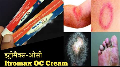 Itraconazole Ofloxacin Ornidazole Clobetasol Propionate Cream L