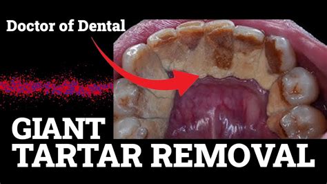 Giant Tartar Removal A Comprehensive Guide To Keeping Your Teeth Clean And Healthy Dental Clinic