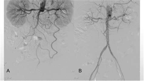 A typical case of endovascular treatment of Leriche syndrome with ...