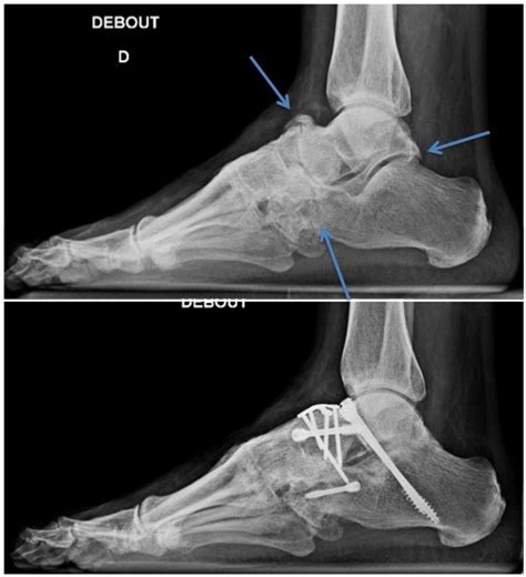 Arthrodesis – Foot and Ankle Institute