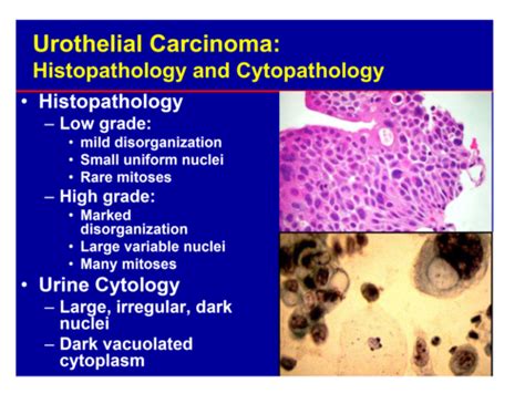 Transitional Cell Carcinoma Cytology