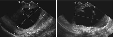 Pelviureteric Junction (PUJ) Obstruction | Abdominal Key