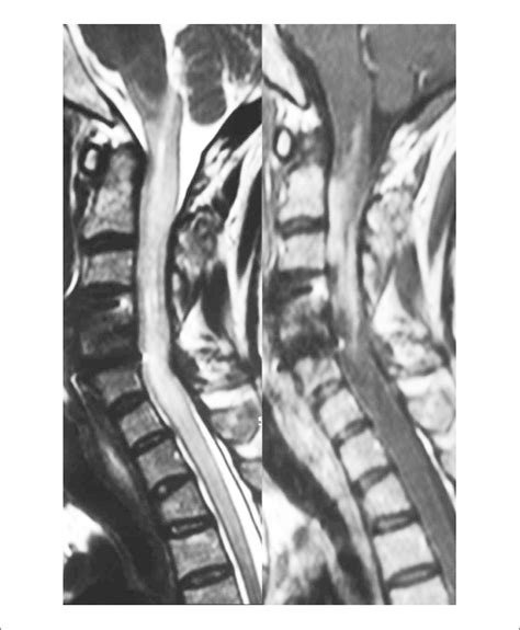 Sagittal T2 Left And T1 Weighted Right Magnetic Resonance Imaging