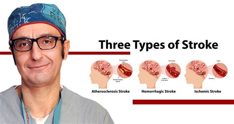 Infographic Of Common Types Of Stroke Panacea Mk