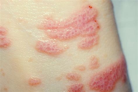 Skin Allergies Whats Causing That Rash Lichen Planus Red Skin