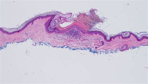 Actinic Keratosis Histology