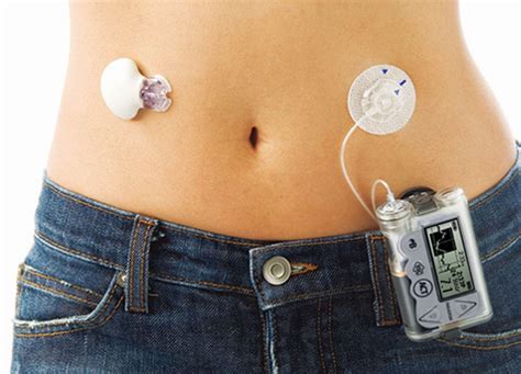 Artificial Pancreas Comes To Help Those Suffering From Diabetes YIIS