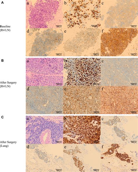 Response To Icotinib Plus Chemotherapy In Pulmonary Atypical Carcinoid