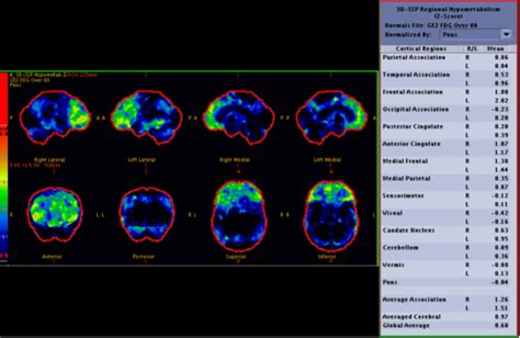 Nuclear Medicine Cerebral Perfusion Scan Statpearls Ncbi Bookshelf