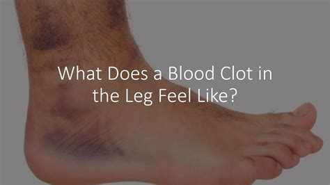 What Does A Blood Clot In The Leg Feel Like Youtube