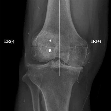 Knee Joint Rotation Was Defined As The Degree Of Deviation Of The