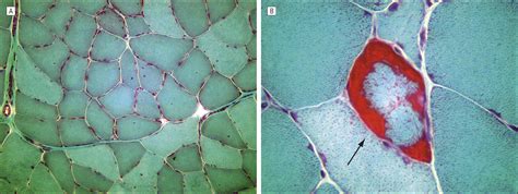 Progressive Myopathy With Multiple Symmetric Lipomatosis Dermatology