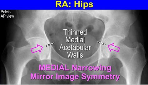 Rheumatoid Arthritis Hips Medial Joint Space Loss Symmetrical Rheumatoid Arthritis