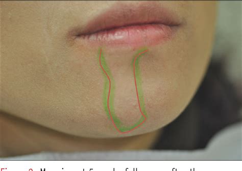 Figure 2 from Hypoesthesia after IAN block anesthesia with lidocaine ...