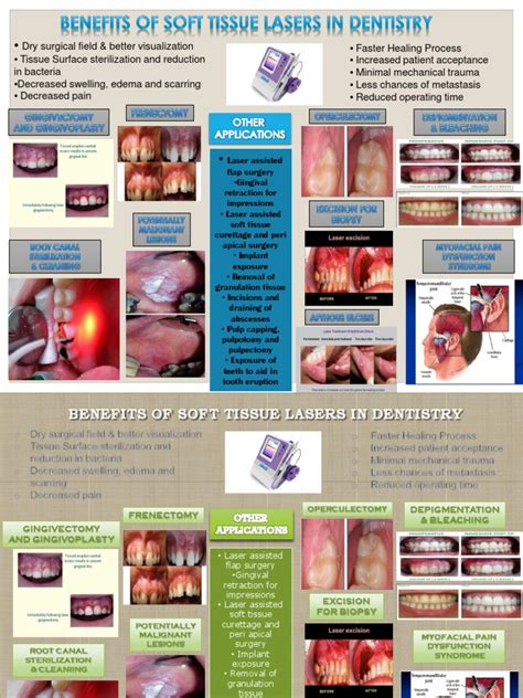 Poster Pdf Surgery Mouth