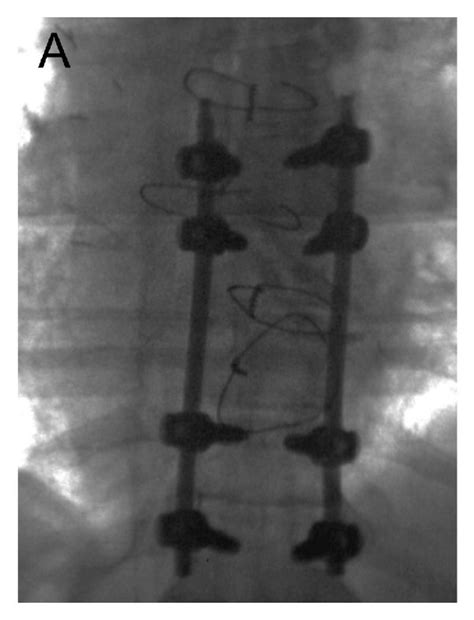 Intraoperative Fluoroscopic Images A Anteroposterior B Lateral