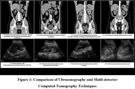 Role Of Unenhanced Multi Detector Computed Tomography In Detection Of