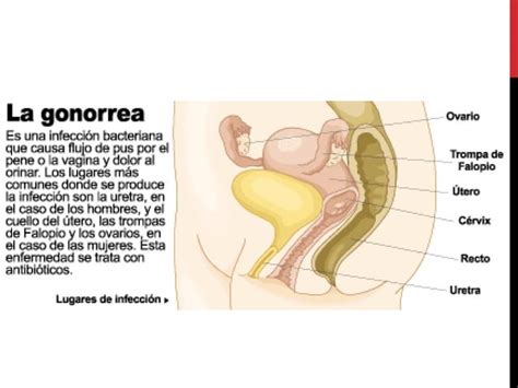 Neisseria Gonorrhoeae Ppt