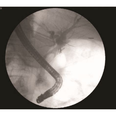 Ercp Showing A Large Filling Defect In A Dilated Common Bile Duct With Download Scientific