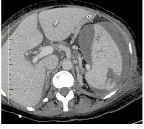 Spontaneous Splenic Rupture As Seen On CECT Portalvenous Phase Axial