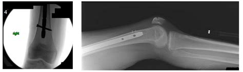 Case Study Of Periprosthetic Fractures After Bisphosphonate Use Dr