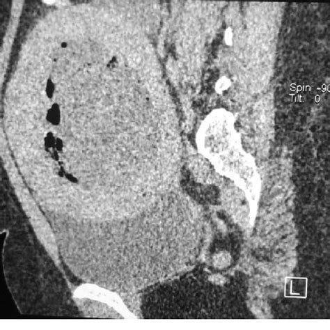 MRI Longitudinal View A Large Intramural Leiomyoma With Areas Of