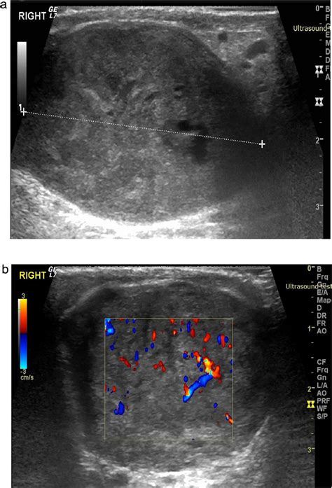 Scrotal Anatomy Ultrasound