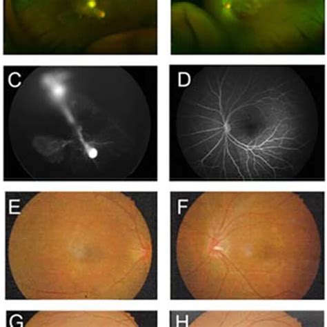 Figure Fundus Photographs And Fundus Fluorescein Angiography Ffa Of