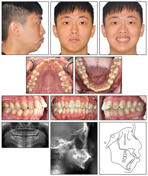 Tad Supported Hyperdivergent Class Ii Nonsurgical Treatment