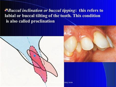 Malocclusion Classification Certified Fixed Orthodontic Courses