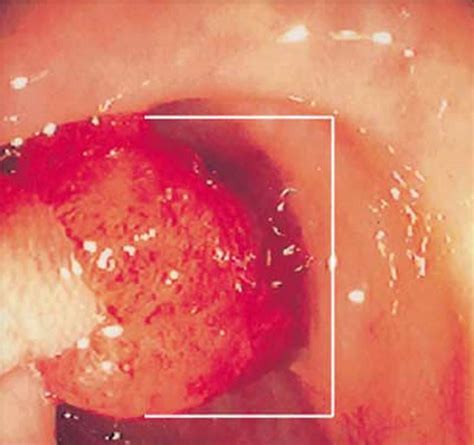 Colon Polyps - Causes, Signs, Symptoms, Prevention,Treatment